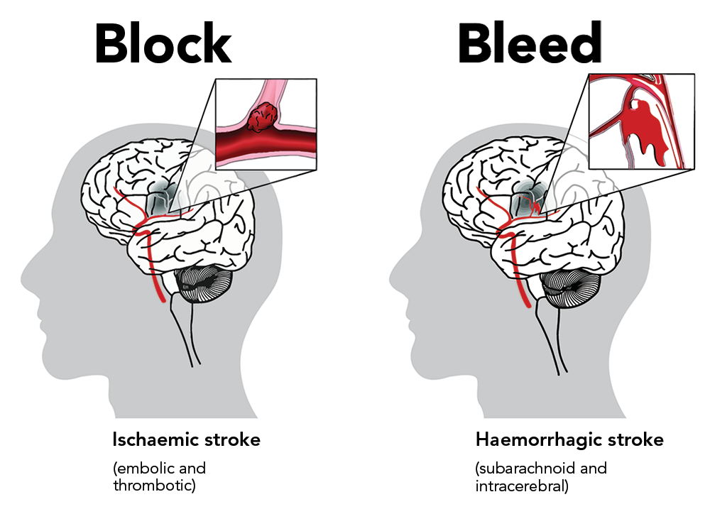 two types of strokes        
        <figure class=