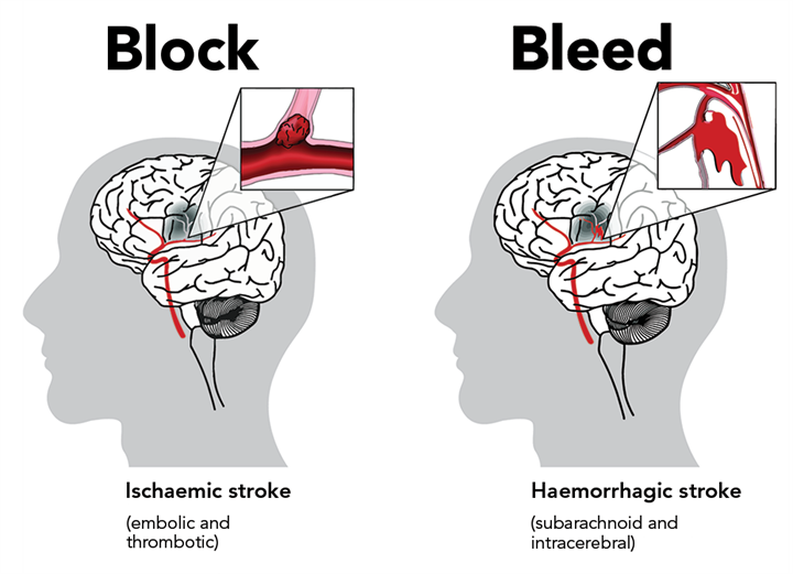 Types Of Stroke