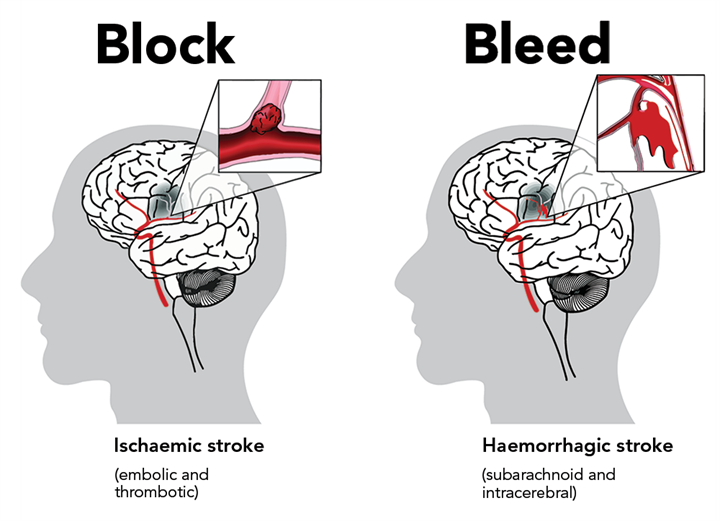 Types of stroke enableme stroke recovery and support